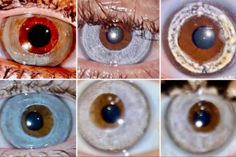 Clínica Eyecos explica cuáles son las ventajas del láser NewEyes frente a la queratopigmentación