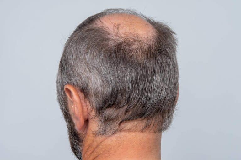 Microinjerto capilar para hombres en verano, con Capilar Innovation Clinic