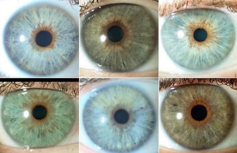 El método de Clínica Eyecos para modificar el color de los ojos de forma segura