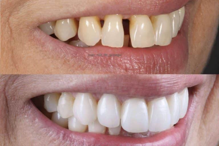 Razones por las que elegir las carillas de porcelana para mejorar la sonrisa