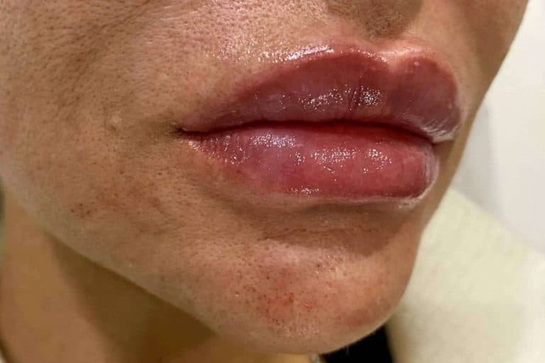 Rellenos de ácido hialurónico para la remodelación y aumento de labios