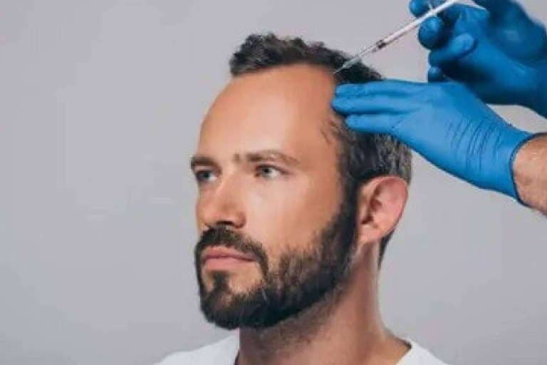 Mesoterapia capilar, tratamiento para la caída del pelo