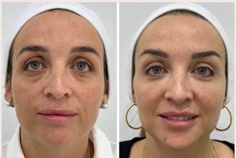 Combatir la flacidez facial, con Clínica VISO