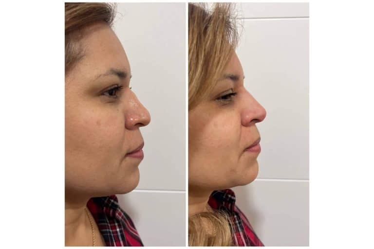 Rinomodelación sin cirugía de forma exitosa en Cecilia Arthur
