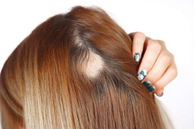 ¿Cómo combatir la alopecia femenina? El método de Capilar Innovation Clinic