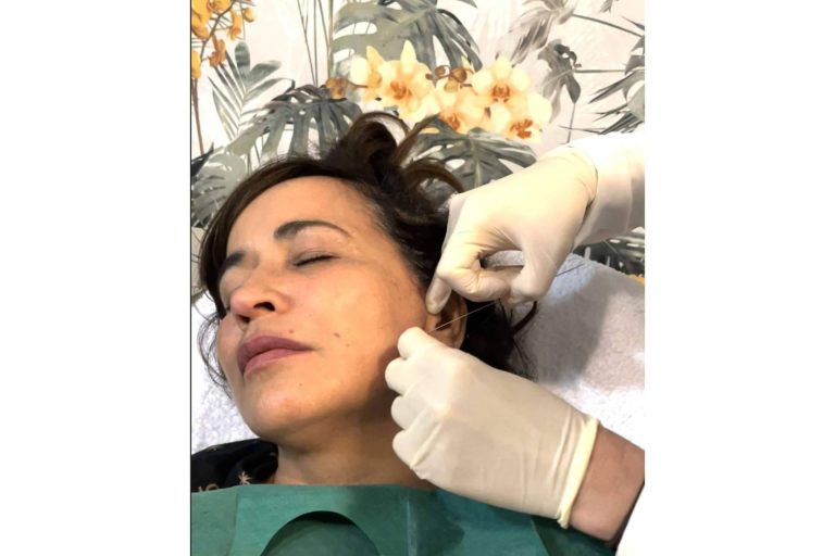 El antes y el después de los hilos tensores, con la Dra. Cecilia Arthur