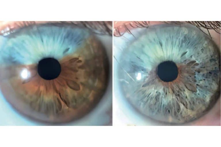 Clínica Eyecos afirma que los heterocromías y los nevus del iris pueden ser tratados con láser