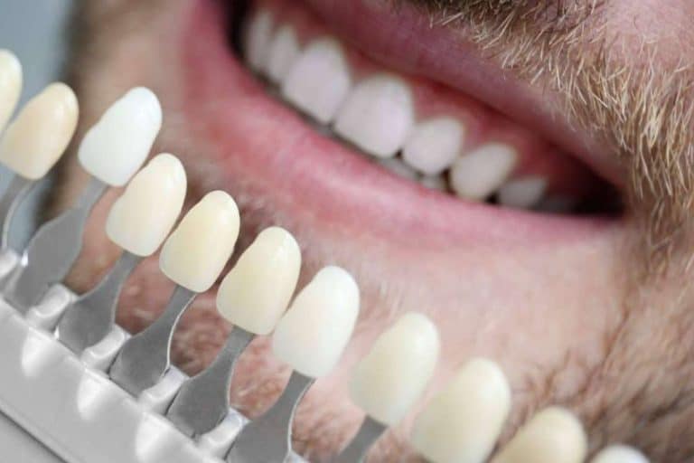 ¿Cuáles son los beneficios de las carillas de composite?, con Clínica Dental Ruiz de Gopegui