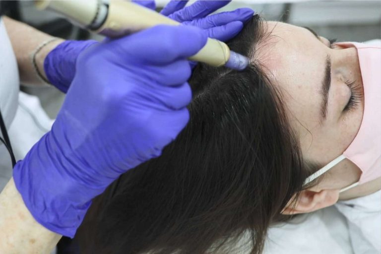 Tratar la alopecia femenina con el innovador tratamiento de bioestimulación del IMD Instituto Médico Dermatológico