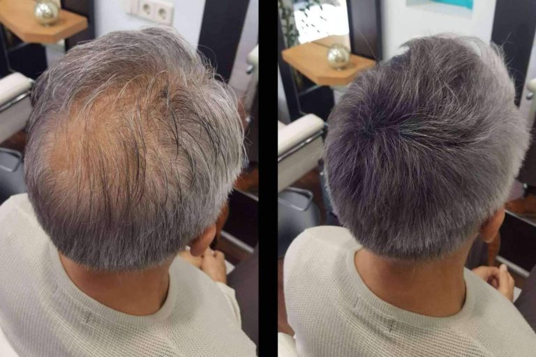 Lion Hair, España es el segundo país del mundo con mayor tasa de pérdida de pelo