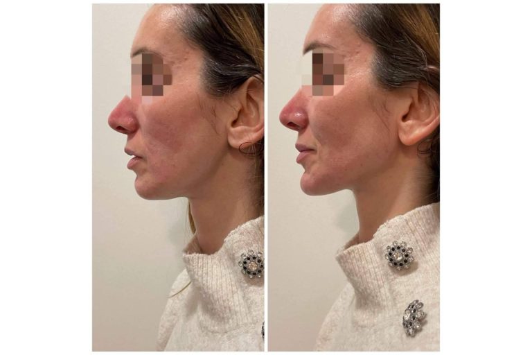 Dónde y por qué realizarse una marcación mandibular, de la mano de Cecilia Arthur