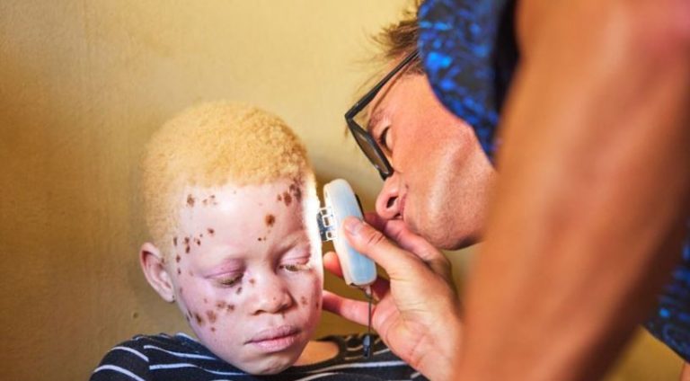 ISDIN ayuda a las personas con albinismo de Mozambique a luchar contra el cáncer de piel