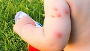La OCU avisa: no gastes en pulseras antimosquitos, su eficacia es mínima y los ultrasonidos no tienen evidencia