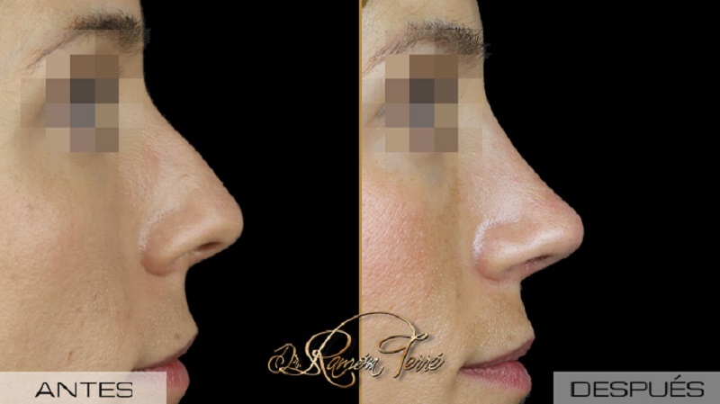 Beneficios de la rinoplastia: estética y salud 2 antes y despues