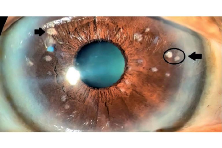 El vitiligo ocular puede tratarse con iridoplastia láser