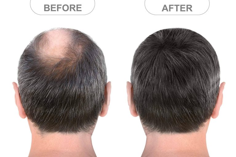 Microinjerto capilar FUE, solución definitiva y mínimamente invasiva para la alopecia androgénica