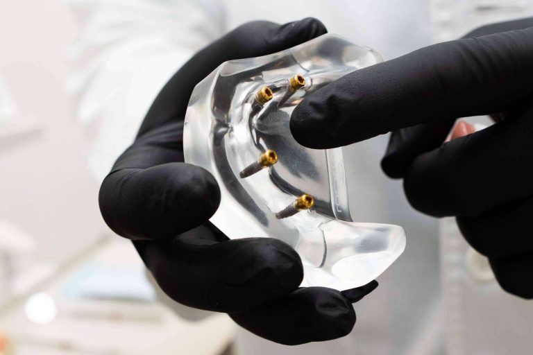 Toda la información necesaria sobre los implantes dentales de la Clínica Calvo de Mora