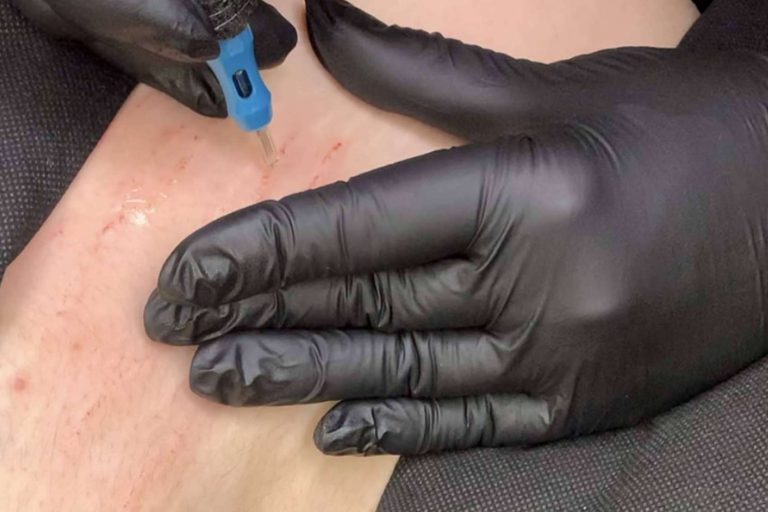 Ideal Academy By Pilar Rico y su solución eficaz para la reducción y eliminación de estrías, el método StopEstrías