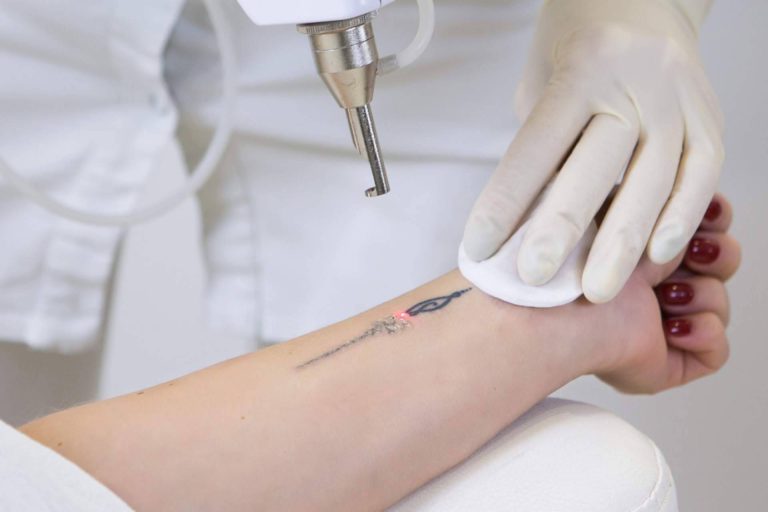 Centro Médico El Pilar dispone de las últimas tecnologías para eliminar tatuajes