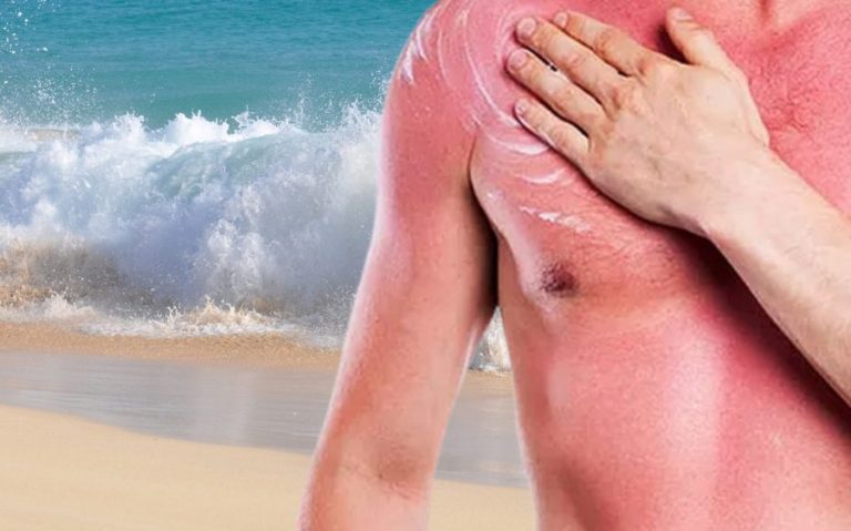 Esto debes hacer si sufres de insolación para calmar tu piel
