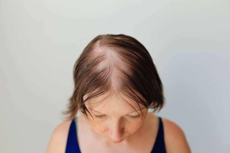 Alopecia femenina. ¿Cómo detectarla y qué tratamientos son los adecuados?