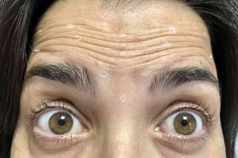 Lucir un aspecto natural y joven con el tratamiento de rejuvenecimiento facial de Clínica Amalfi