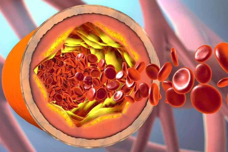 ReduCol 25, la fórmula innovadora con levadura roja de arroz rojo de Beverly Nutrition