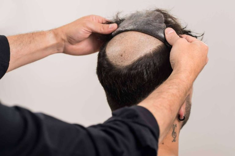 Un mercado en auge, las prótesis capilares para hombre con Hair Inspira