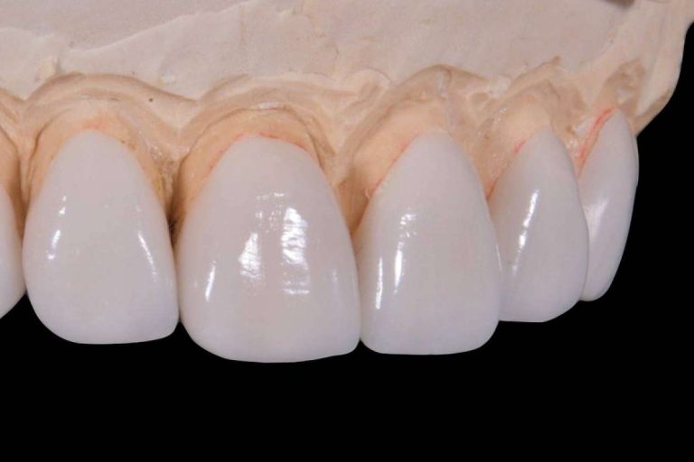 Clínica Calvo de Mora explica por qué las carillas estéticas en porcelana y composite son unas de las más populares