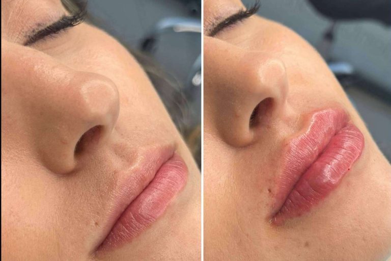 Clínica MG Dental & Estética Facial, expertos en vial ácido hialuronico labios