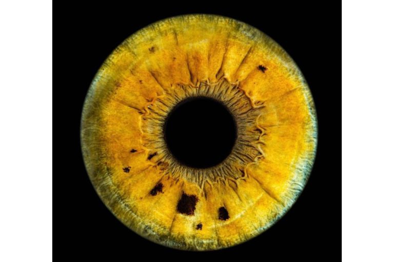 Celebridades con heterocromía ocular, de la mano de Clínica Eyecos