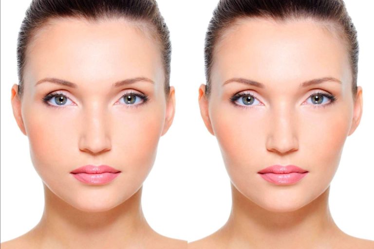 Bichectomía química, la innovadora técnica del Dr. Tallaj que elimina las bolsas de Bichat sin pasar por quirófano