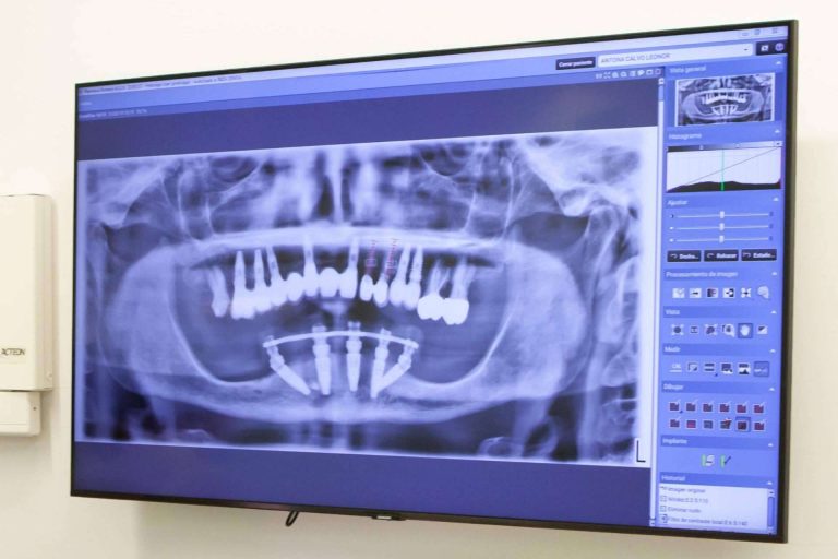 ¿Qué es el edentulismo y cómo tratarlo?, con Clínica Dental Ruiz de Gopegui
