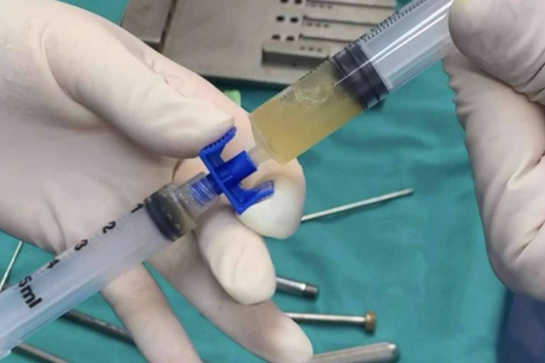 ¿En qué consiste la traumatología regenerativa?