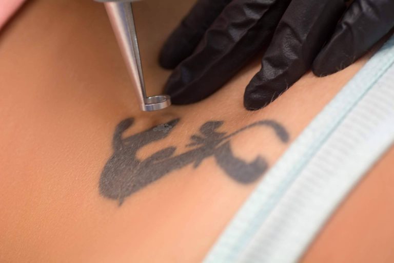 Eliminar tatuajes a color ya es posible en Ink Láser Alicante