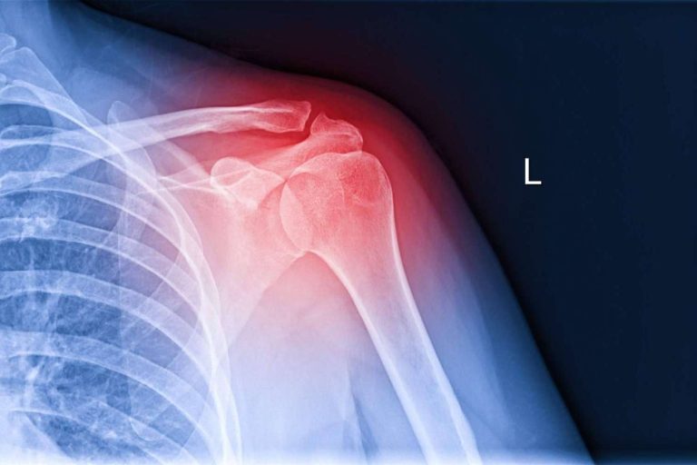 El tratamiento de la lesión de manguito rotador del Dr. Miguel Romero