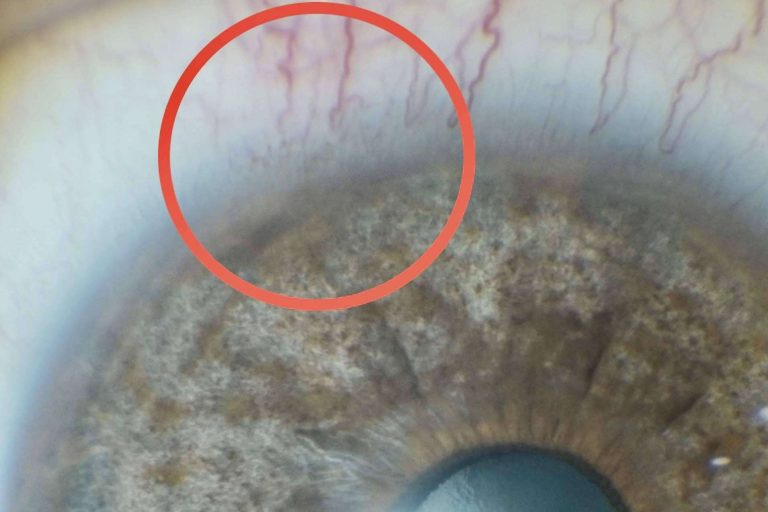 En qué consiste el tratamiento láser de las manchas pigmentarias de la conjuntiva