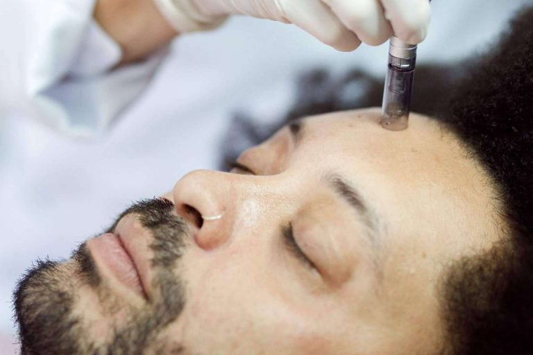 Todo sobre el microneedling facial y capilar, con Malecare