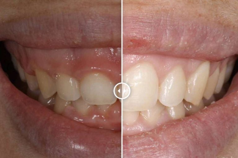 ¿Cómo corregir la sonrisa gingival?, por Clínica Dental Ruiz de Gopegui