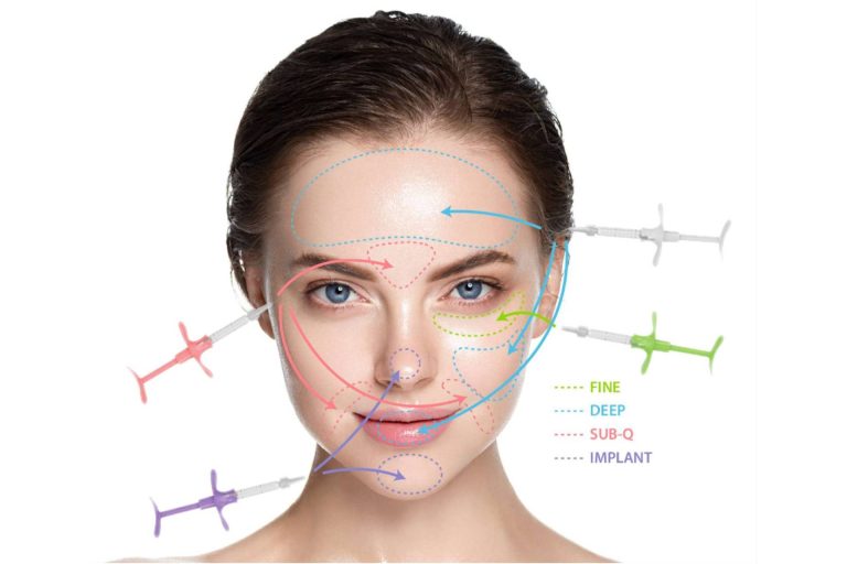 Relleno dérmico de próxima generación y la seguridad de Exquiller