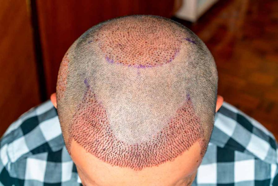Implante de pelo: tendencia al alza