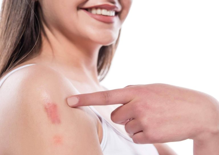 En el Centro Estética El Pilar cuentan con técnicas avanzadas para eliminar cicatrices