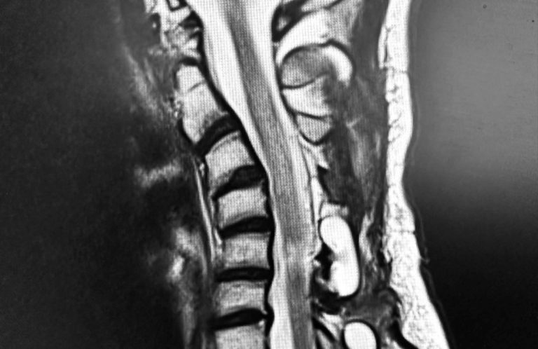 Cifosis post-laminectomía cervical