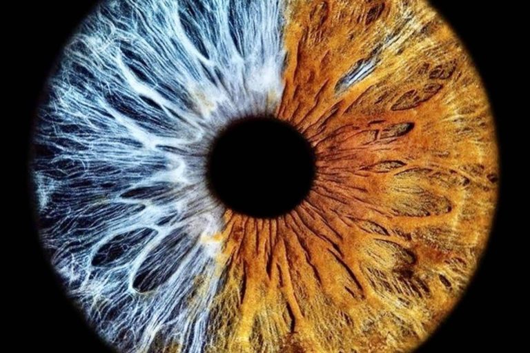 La iridoplastia laser NewEyes no influye desfavorablemente en la visión