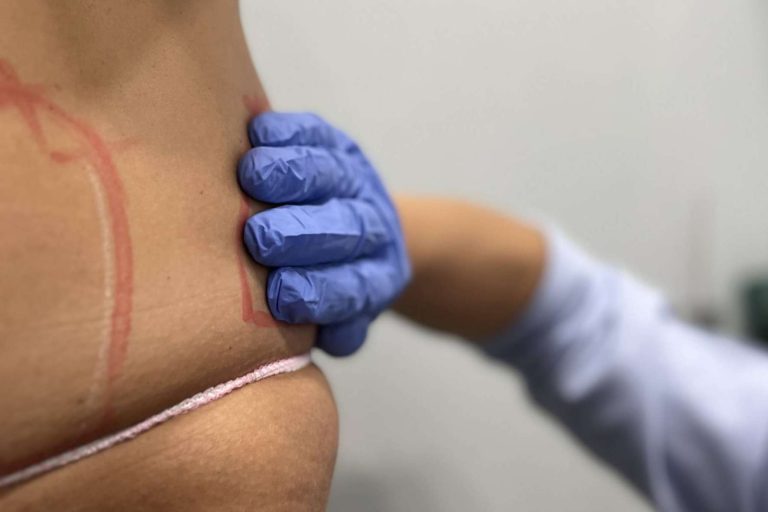 Método Láserfit Medical, revolucionario tratamiento corporal para reducir grasa localizada en 360Clinics