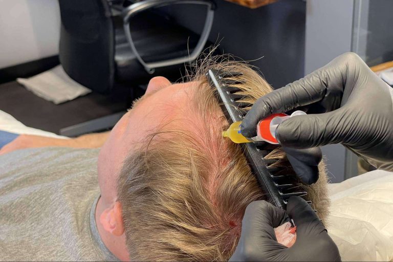 ¿Qué es la mesoterapia capilar?, por Qualevita