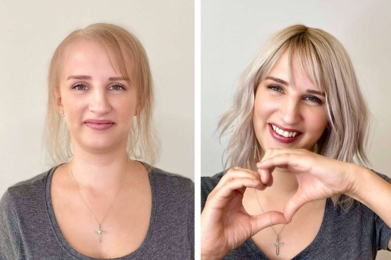 Fermín Peluqueros enumera los múltiples beneficios del tratamiento de MicroLíneas