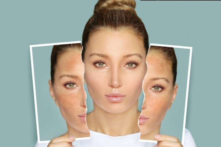 El Vortex Peel es uno de los mejores peelings de alta intensidad