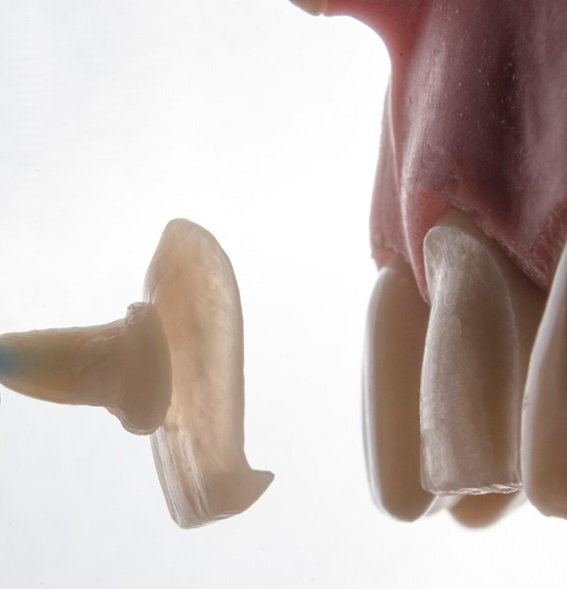 ¡Sonrisas Transformadas! Descubre los 5 Tratamientos de Estética Dental Más Demandados 4 carillas dentales