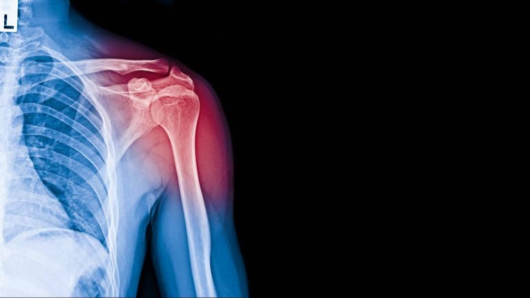 ¿Qué es todo lo que hay que saber sobre la tenditis de supraespinoso?, por el Dr. Miguel Romero